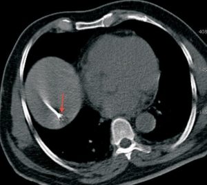 radiofrequency-ablation-of-solitary-liver-metastasis-3