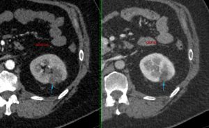 cryoablation-of-renal-tumors-4