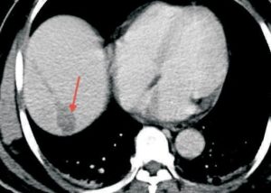 radiofrequency-ablation-of-solitary-liver-metastasis-4